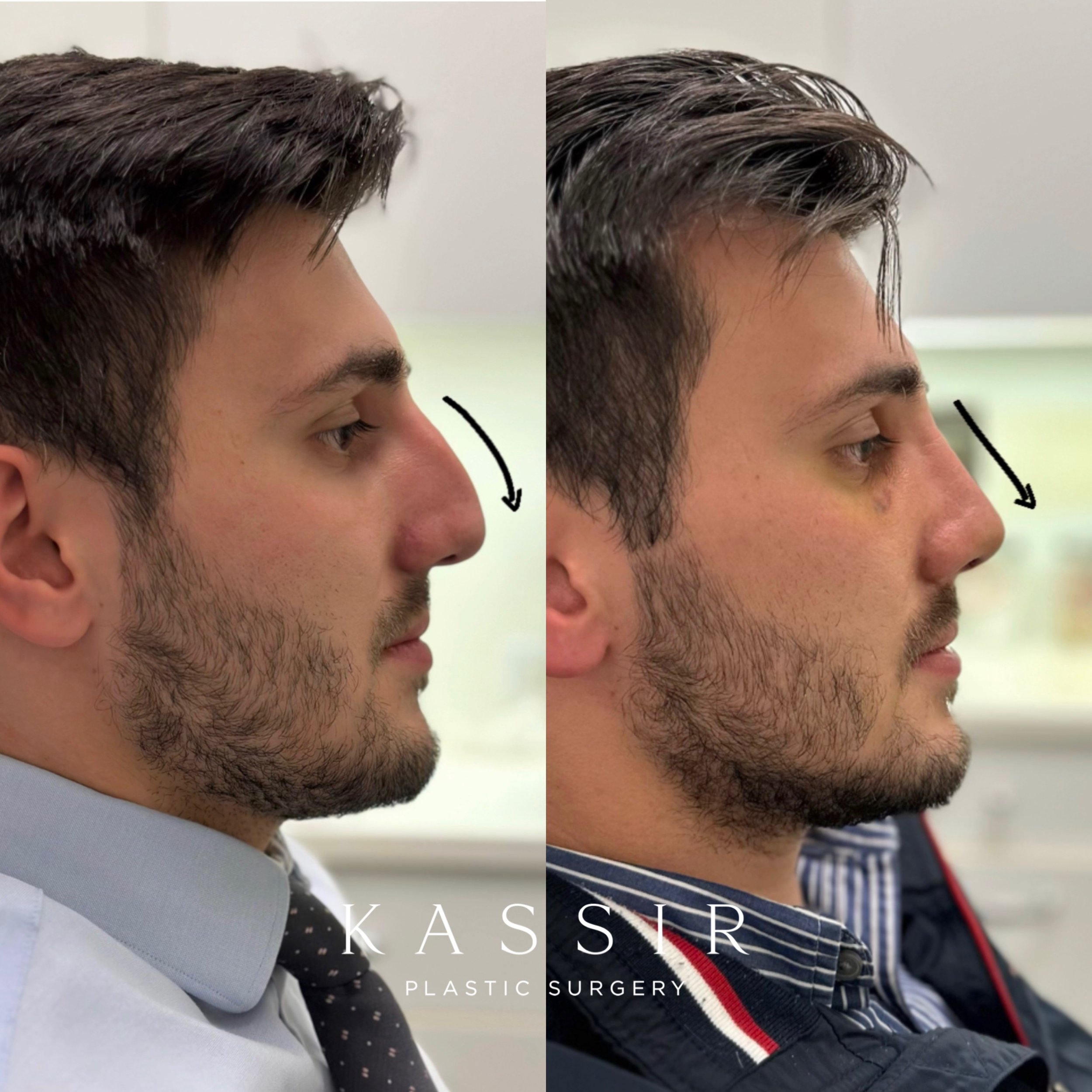 NYC Male Facelifts: Recovery and Transformation — Kassir Plastic Surgery in  NY and NJ