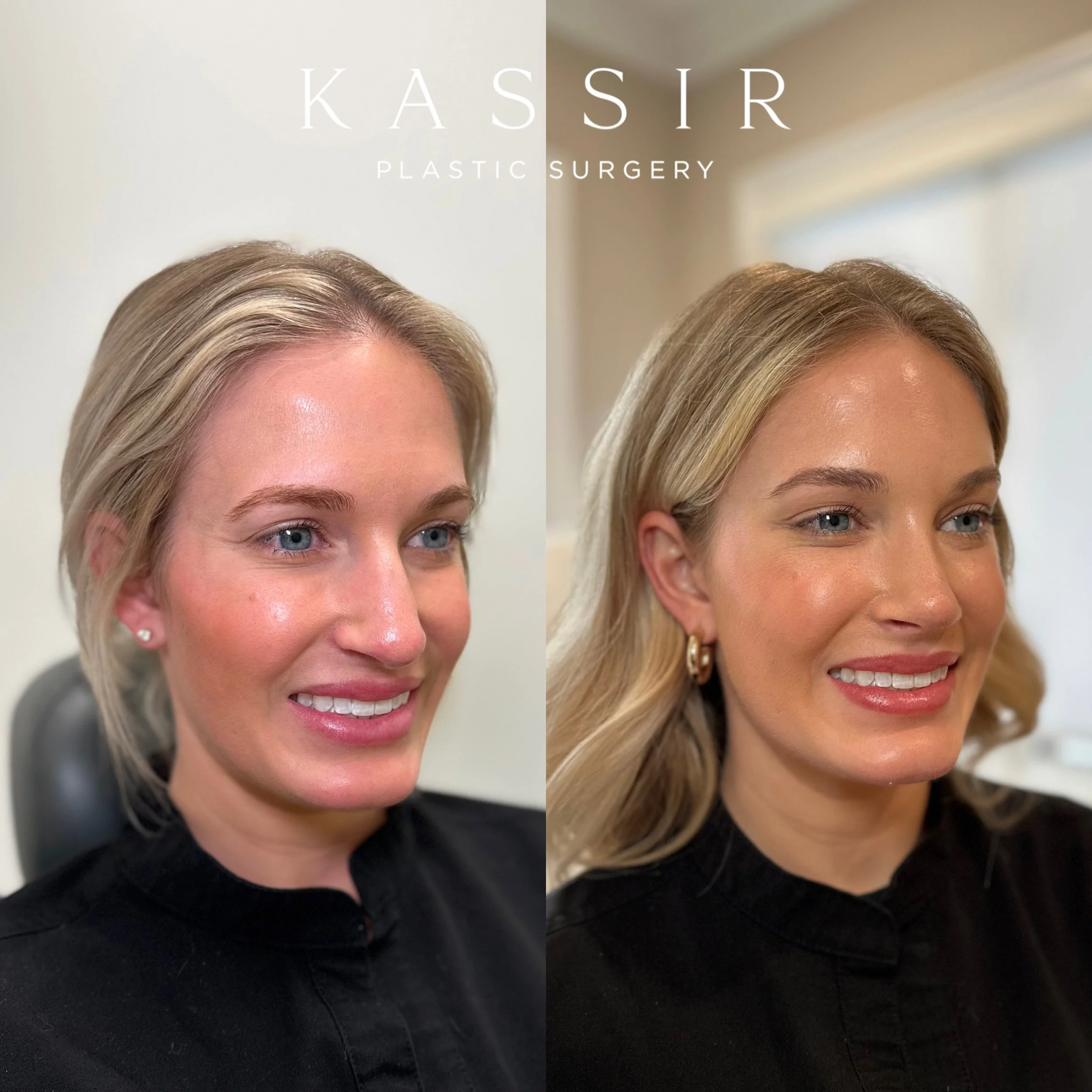 Transforming Beauty The Art of Endoscopic Brow Lift and Rhinoplasty by