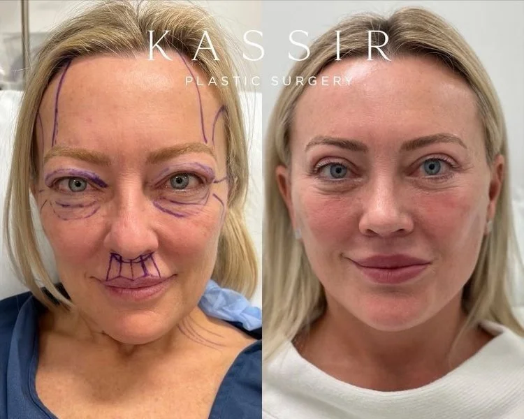 Facelift Before and After Image Link to Gallery