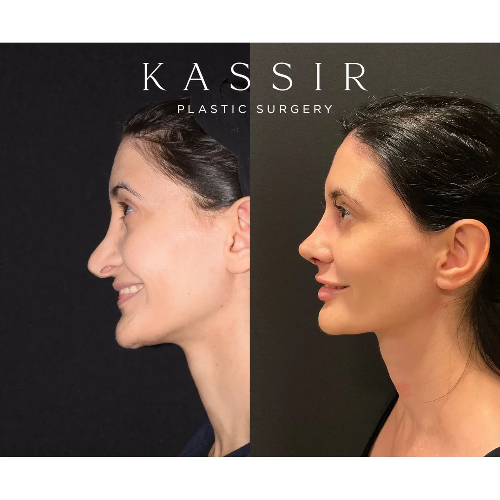 Best Revision Rhinoplasty Surgeon in the US — Kassir Plastic Surgery in