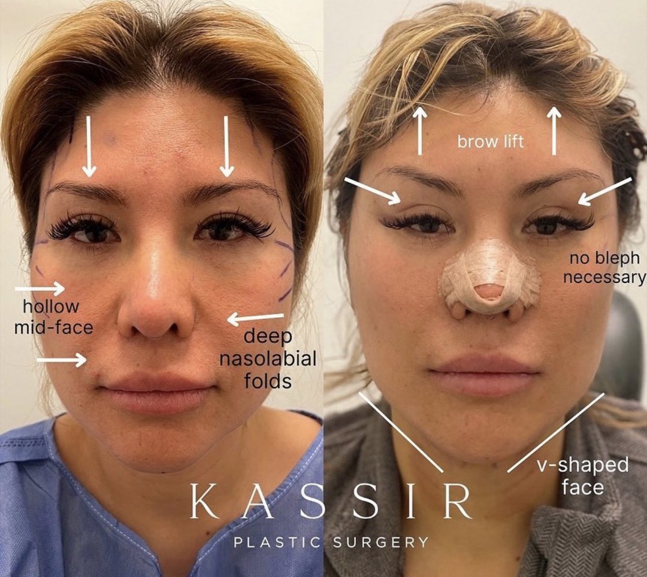 Scarless Face & Brow Lift — Kassir Plastic Surgery in NY and NJ
