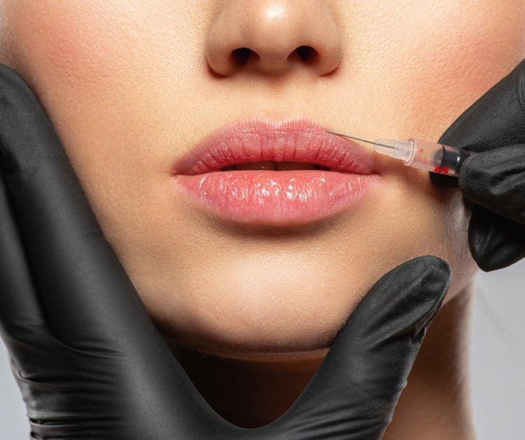 Lip Filler Aftercare: 8 Tips from Expert Dermatologists - Laser NY
