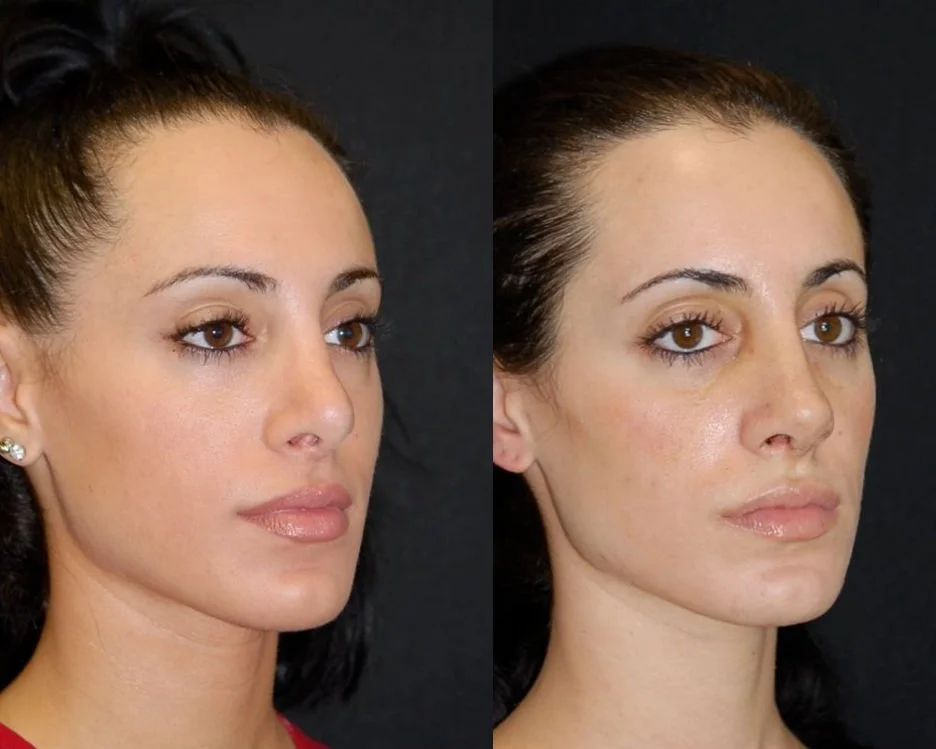 Revision Rhinoplasty Patient