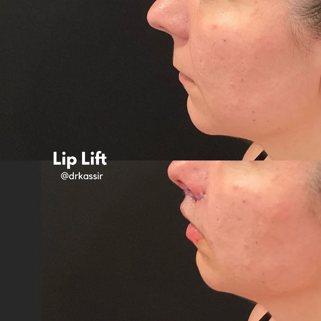 LIP LIFT 11.jpeg