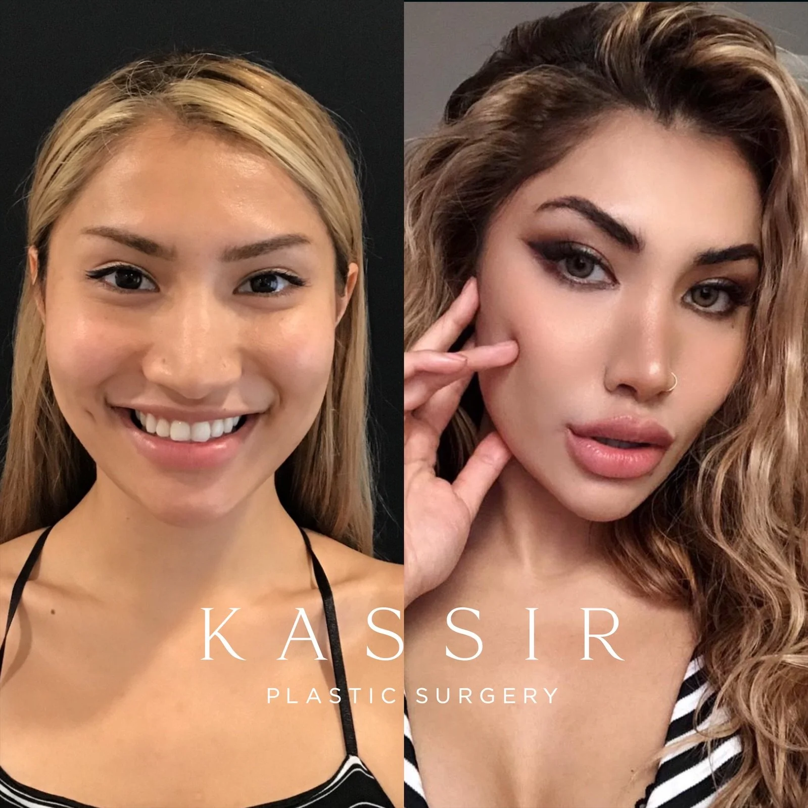 Best Rhinoplasty I Designer Rhinoplasty by Dr. Kassir — Kassir Plastic