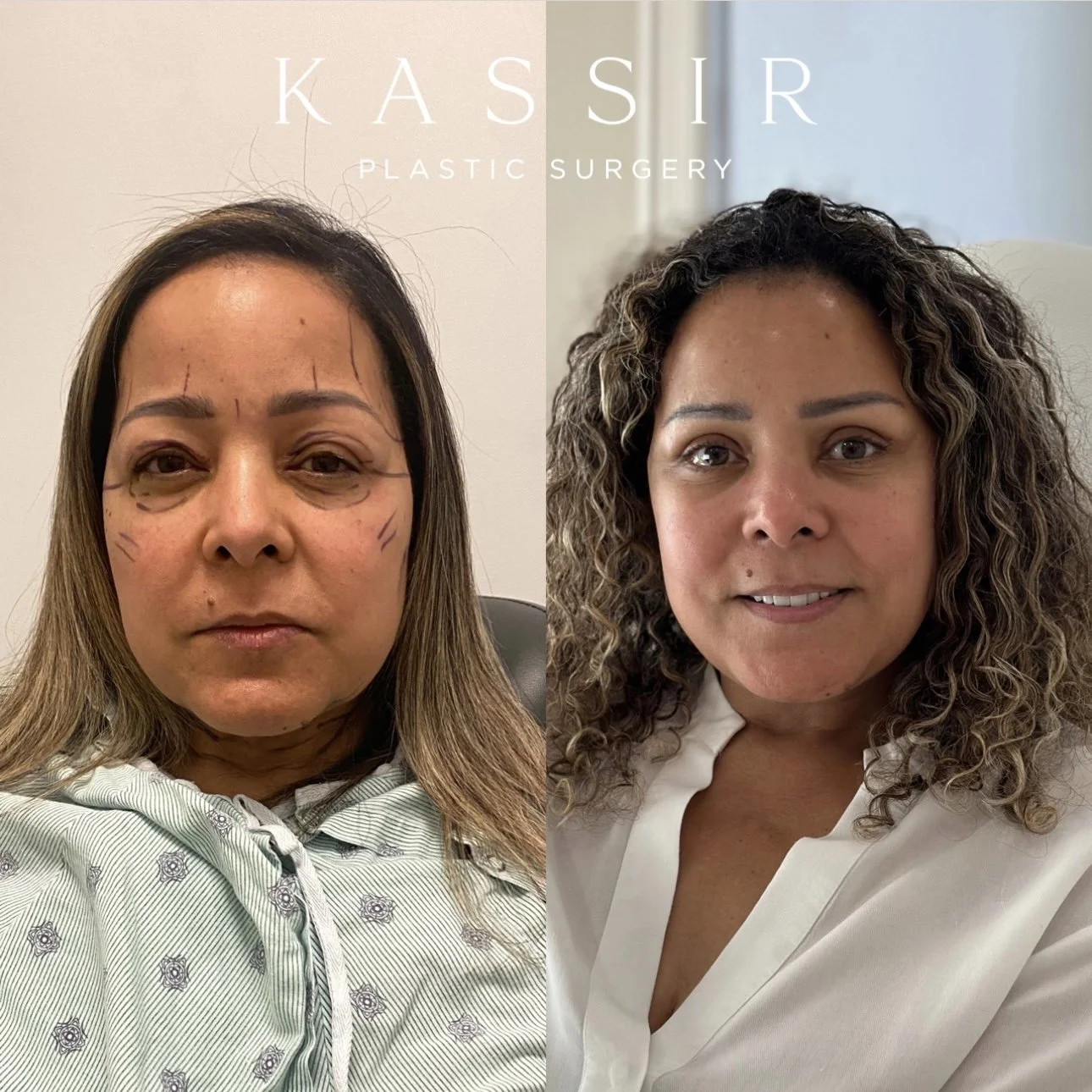 Achieving a Youthful Appearance with a Scarless Facelift — Kassir
