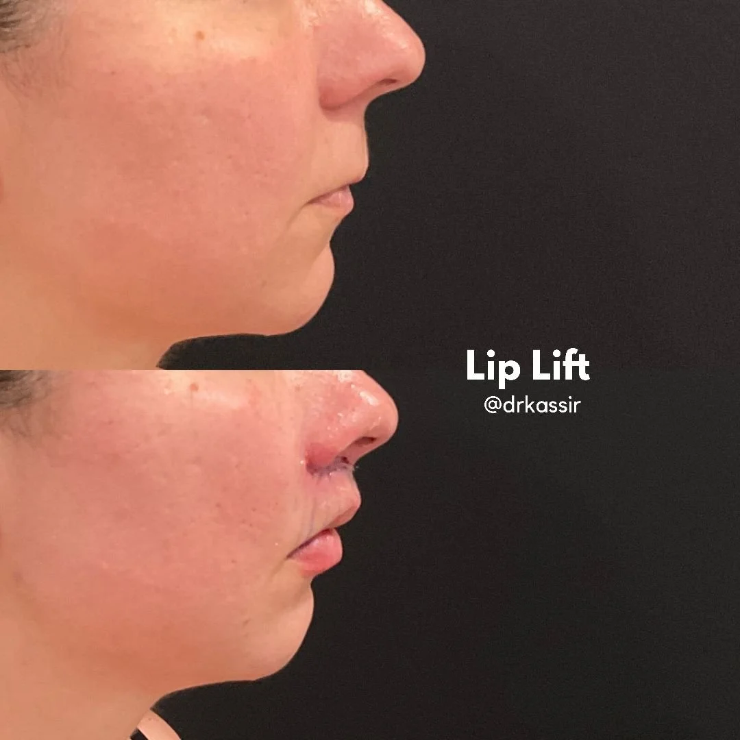 LIP LIFT 13.jpeg
