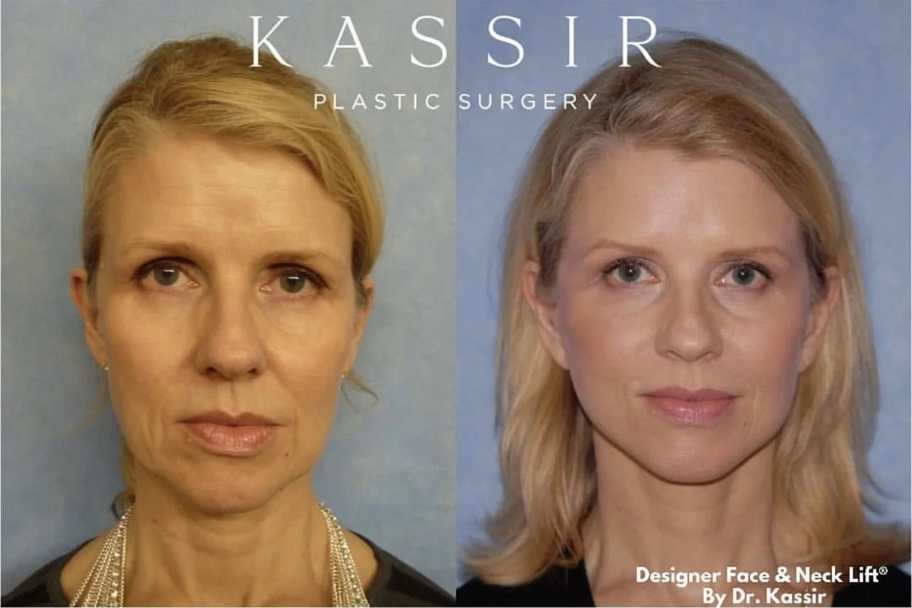 Kassir Plastic Surgery NY and NJ Cosmetic Surgeon for face and body