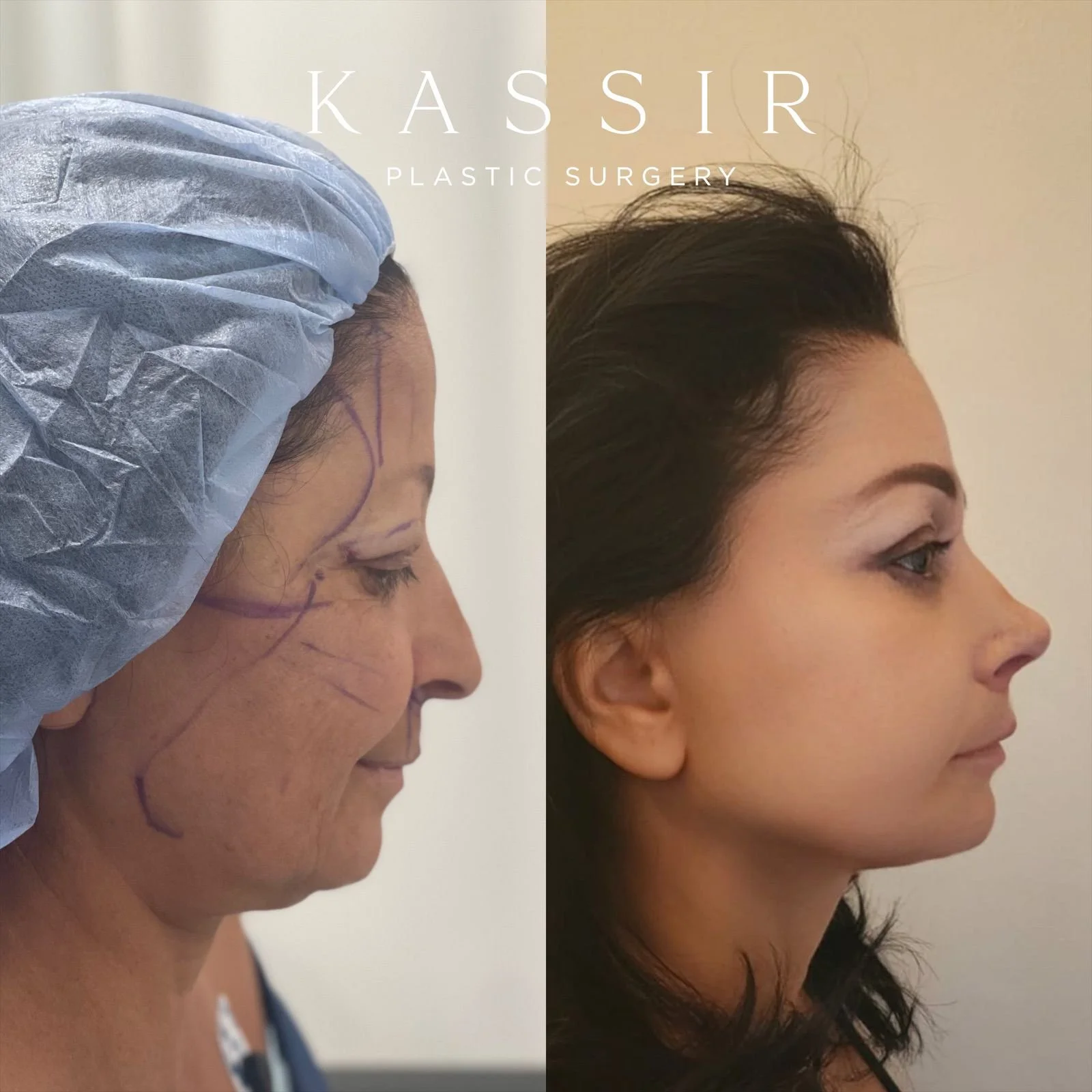 Discover the Mini Facelift Cost, Before and After, and More — Kassir Plastic Surgery in NY and NJ