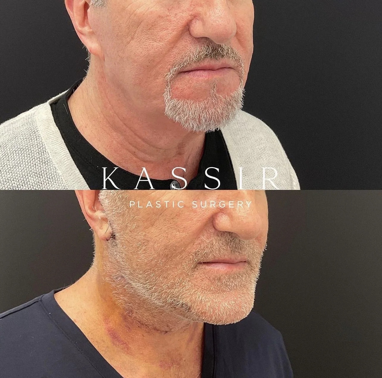 Facelift Patient Before and After — Kassir Plastic Surgery in NY and NJ