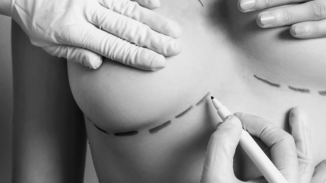 Breast Explant Surgery New Jersey