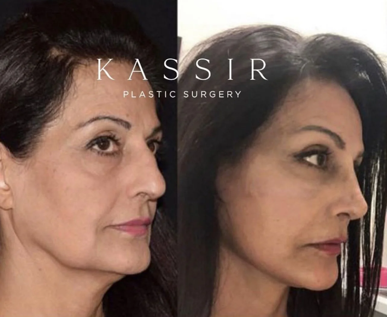 Discover The Mini Facelift Cost Before And After And More Kassir 