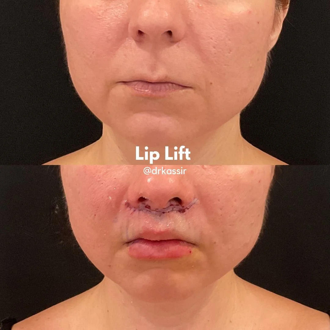 LIP LIFT 10 (1).jpeg