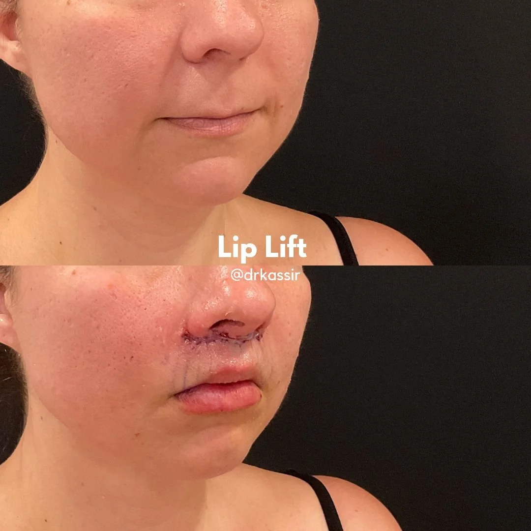 LIP LIFT 9 (1).jpeg