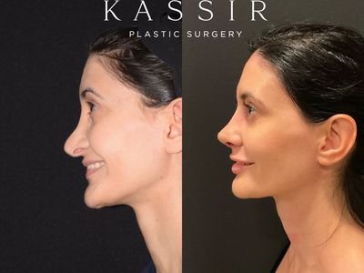 Before and After Facelifts. All healing stages and tips for a quick  recovery — Kassir Plastic Surgery in NY and NJ