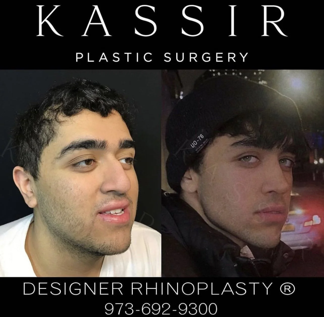 Kassir Plastic Surgery NY and NJ Cosmetic Surgeon for face and body