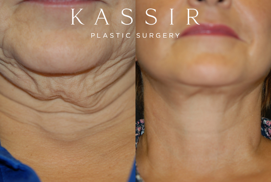 Best Neck Lift Surgeon Near Me — Kassir Plastic Surgery in NY and NJ