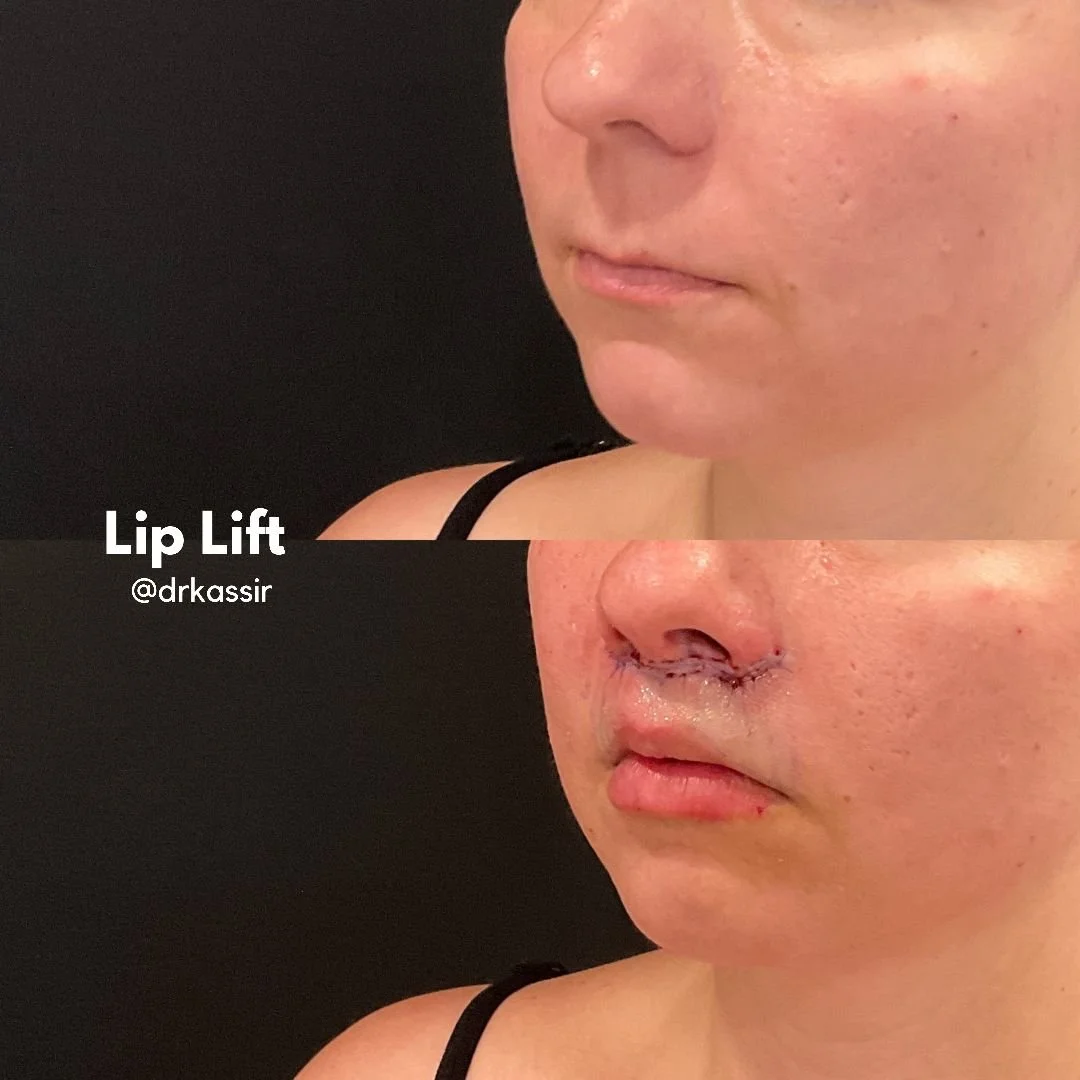 LIP LIFT 12 (1).jpeg