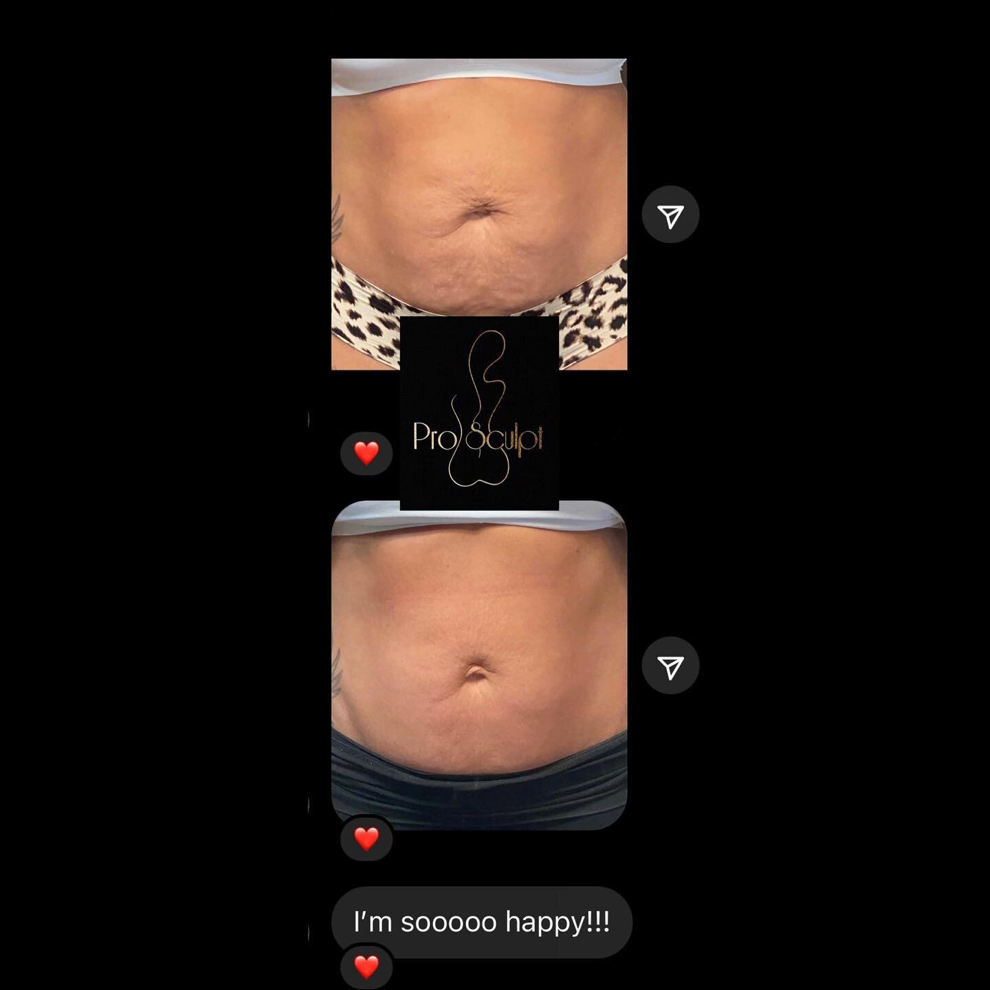 Another HAPPY CLIENT🥰 This is after 1 session of my 45min contouring treatment! Ladies! You do not always need surgery for post baby body tummy&rsquo;s or for lower abdomen skin that has lost its elasticity from losing weight etc. Here is your proof