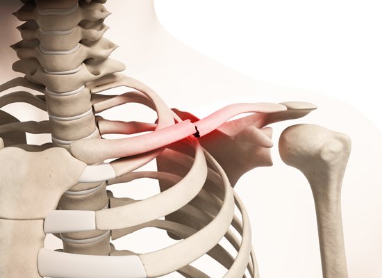 Clavicle Fracture — Miami Bone And Joint Institute Premier Center For