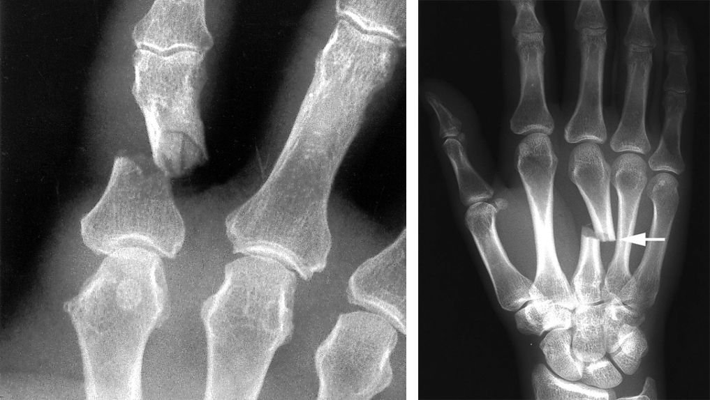 Fracture phalanx miami bone joint institute premier center for