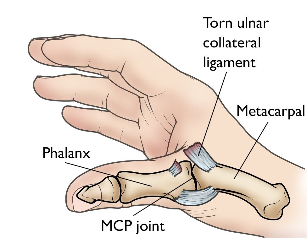 Collateral ligament injury miami bone joint institute premier