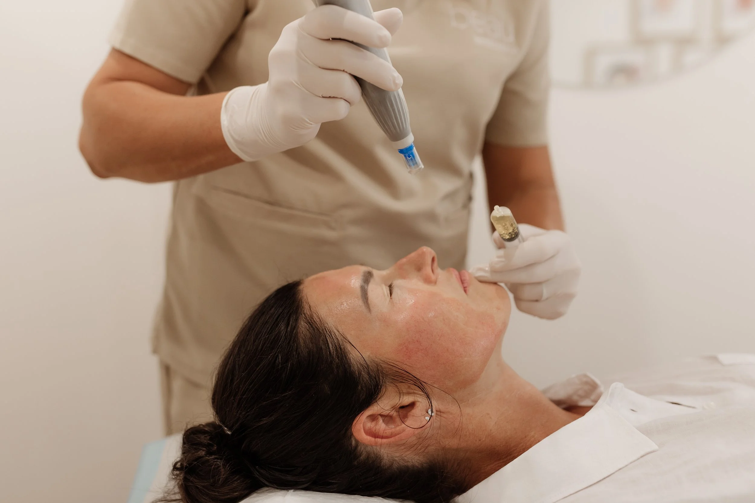Skin Needling Treatments Newcastle — beau aesthetica