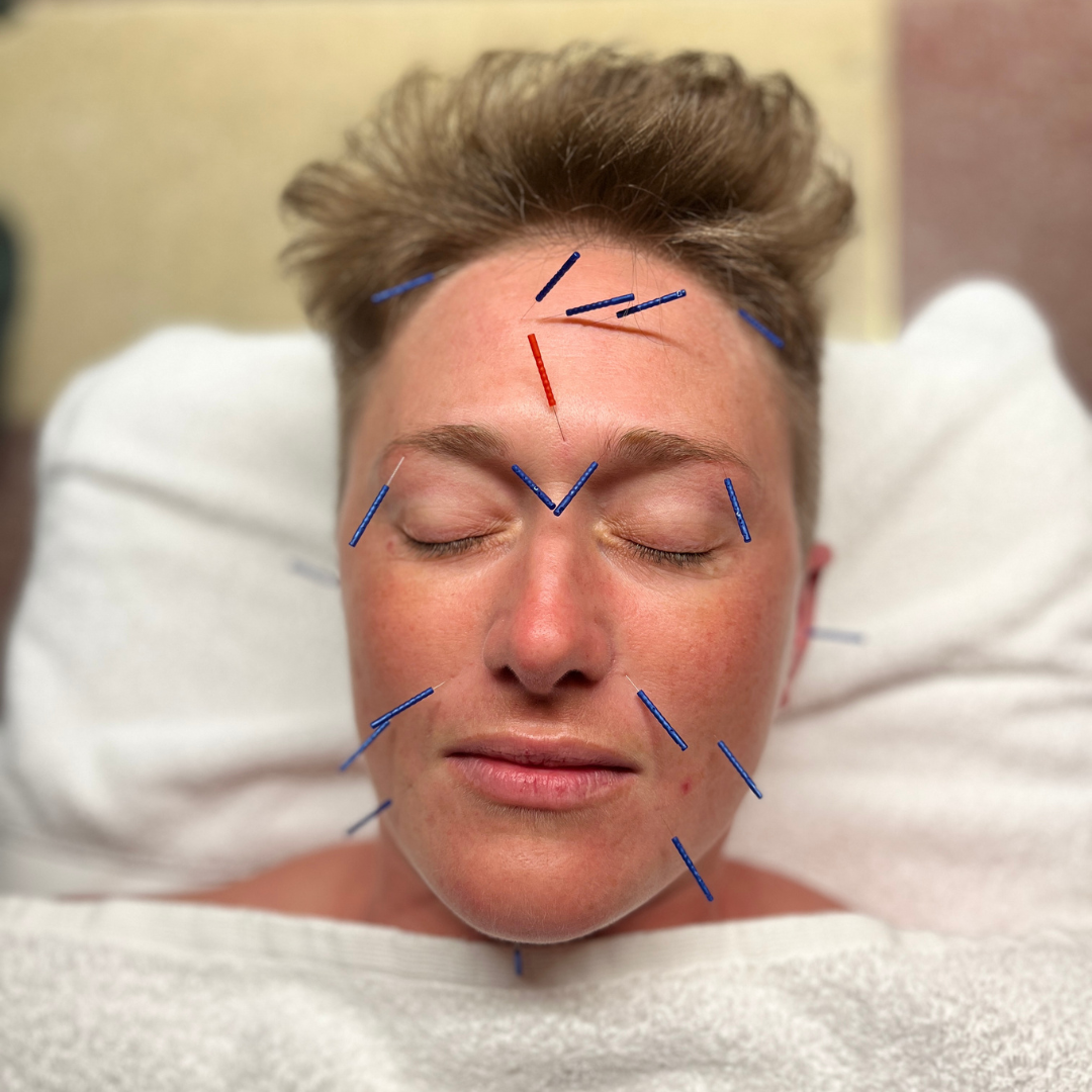 Cosmetic Acu-Facial - The Melbourne Apothecary