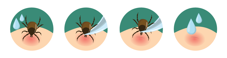 Illustrated steps on how to remove a tick