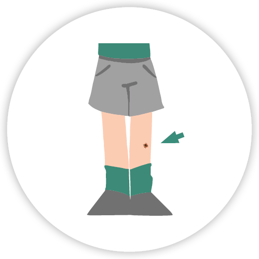 Illustration of a boy's legs with an attached tick