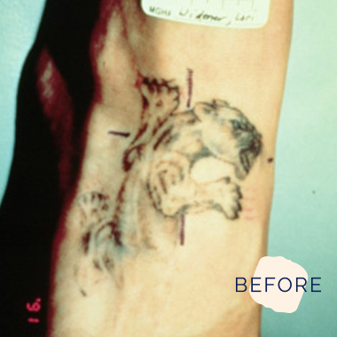 Tattoo Removal — Dr David Scott