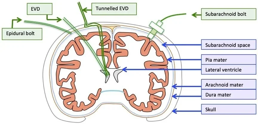 Diagram of brain anatomy showing ventricular system, subarachnoid space, pia mater, arachnoid mater, dura mater, and skull, with labels for subarachnoid bolt, epidural bolt, tunneled EVD, and EVD.