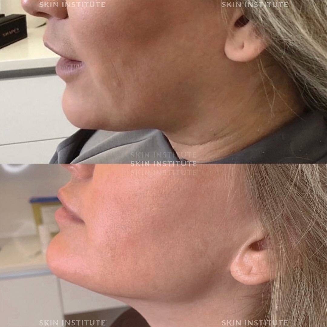 A touch of dermal filler in the key contour areas of the face can create millimetre changes that make a big impact!

Areas we treat for full facial balancing: 
✨ cheeks 
✨ chin 
✨ jaw 
✨ lips

Think of facial optimization like buying shoes! You would