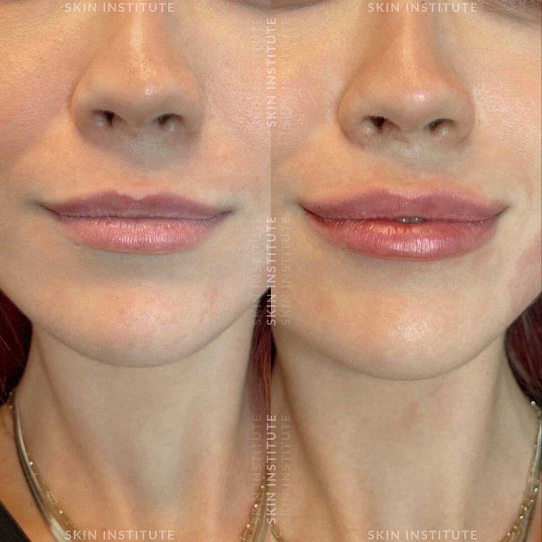 Subtle yet impactful 💋

The goal: maintaining the natural shape of the lips while boosting volume and hydration. 

Think we nailed it? 

BOOK YOURS
📍Toronto &amp; Oakville
📱 416-441-9500
💌 info@skininstitute.ca