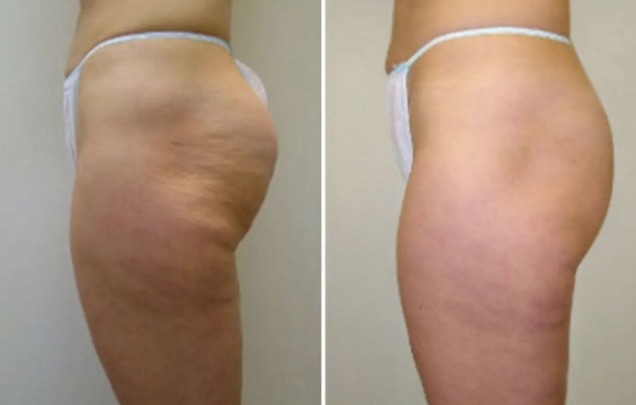 VelaShape III
