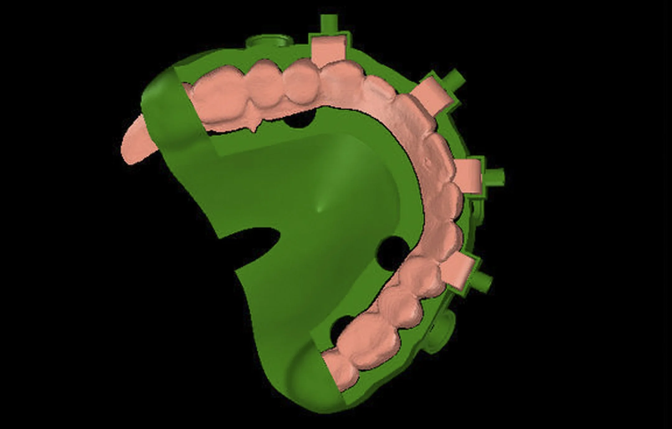 SGT Guides Stackable Surgical Guides Dental Implant Guided Surgery