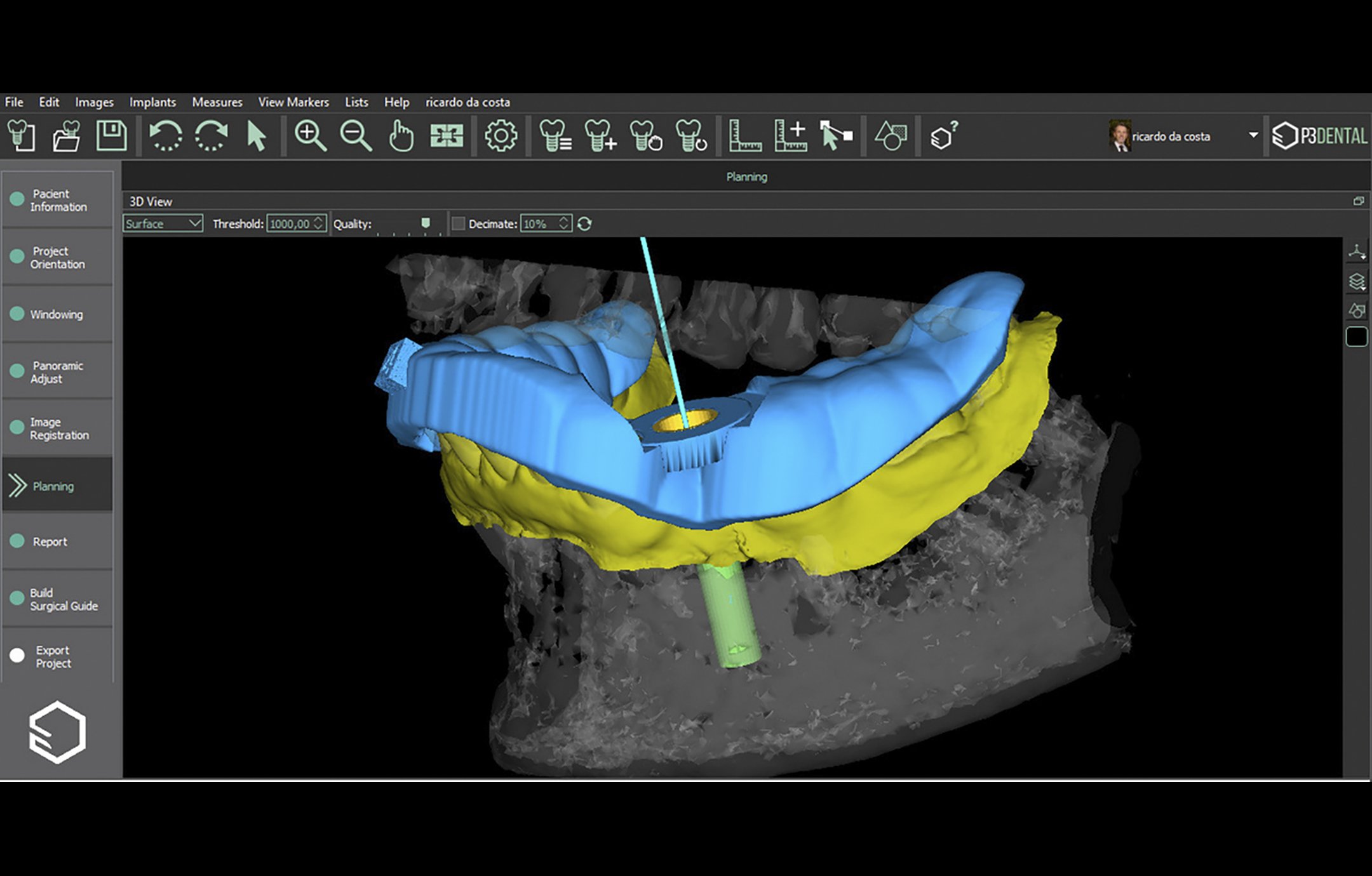 Tooth Supported Guide Project_1.jpg