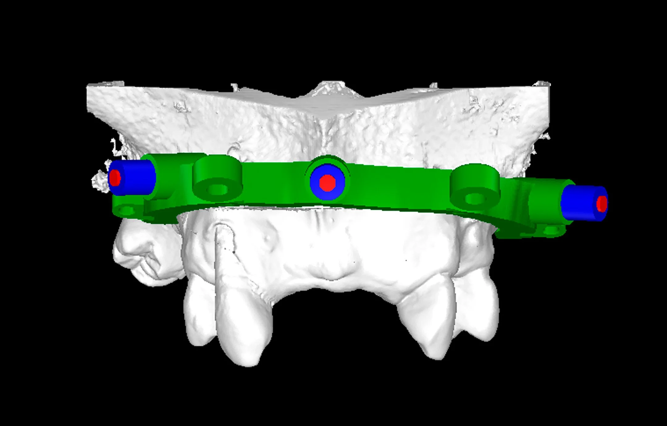 SGT Guides Stackable Surgical Guides Dental Implant Guided Surgery