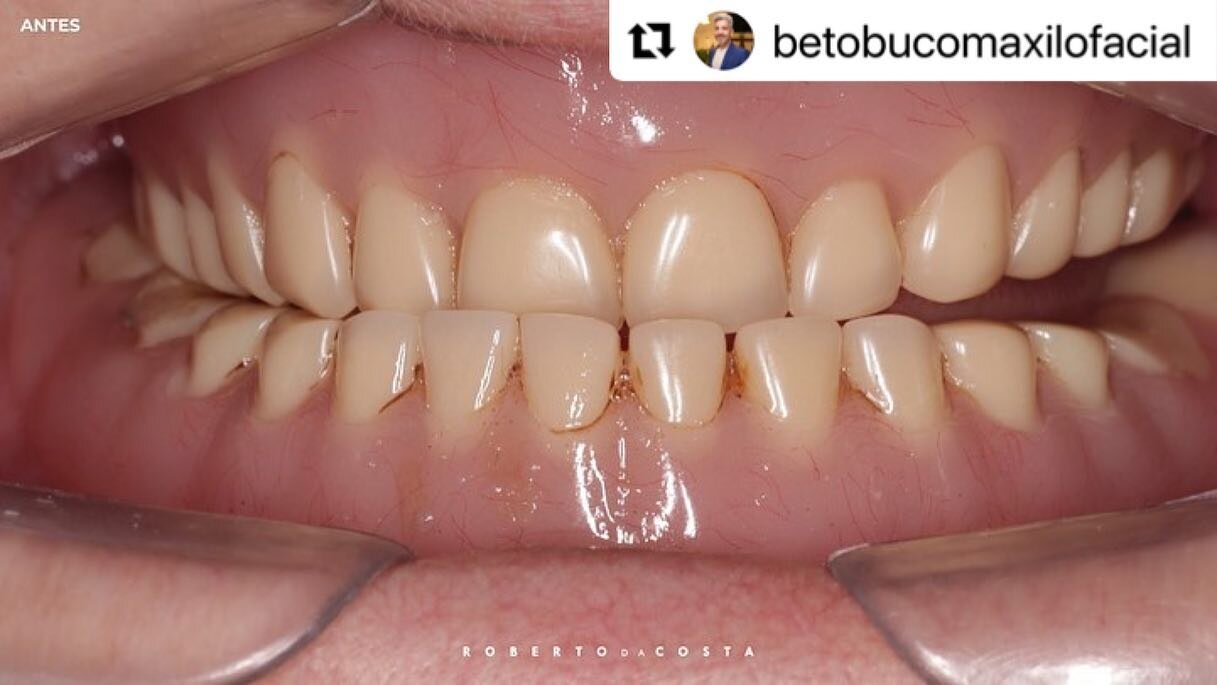 What a beautiful transformation and great teamwork! Always #PlanItRight 
・・・
Rehabilitation of the lower full arch (All on 4) with implants and prosthesis of the Protocol + Upper PT type. Planning @sgtguides and @ ricardodacostax5 . Soft tissue surge