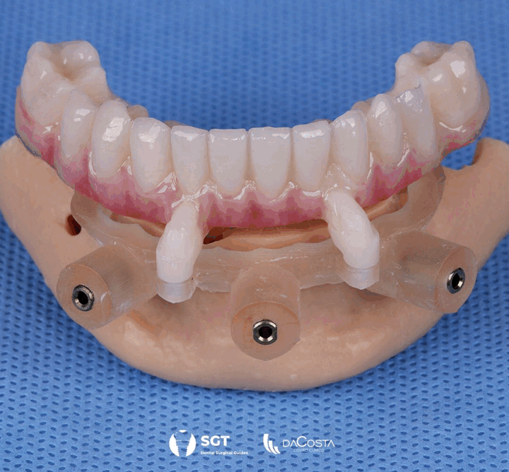 Full Arch Immediate Loading without Denture Conversion