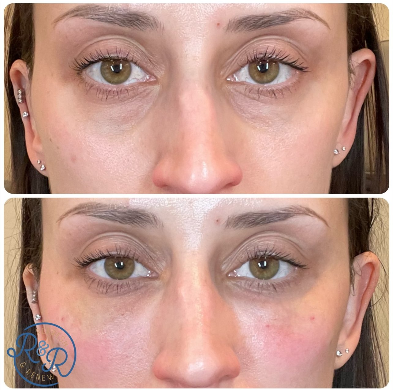 Biostimulators: Harnessing the Power of Regenerative Aesthetics