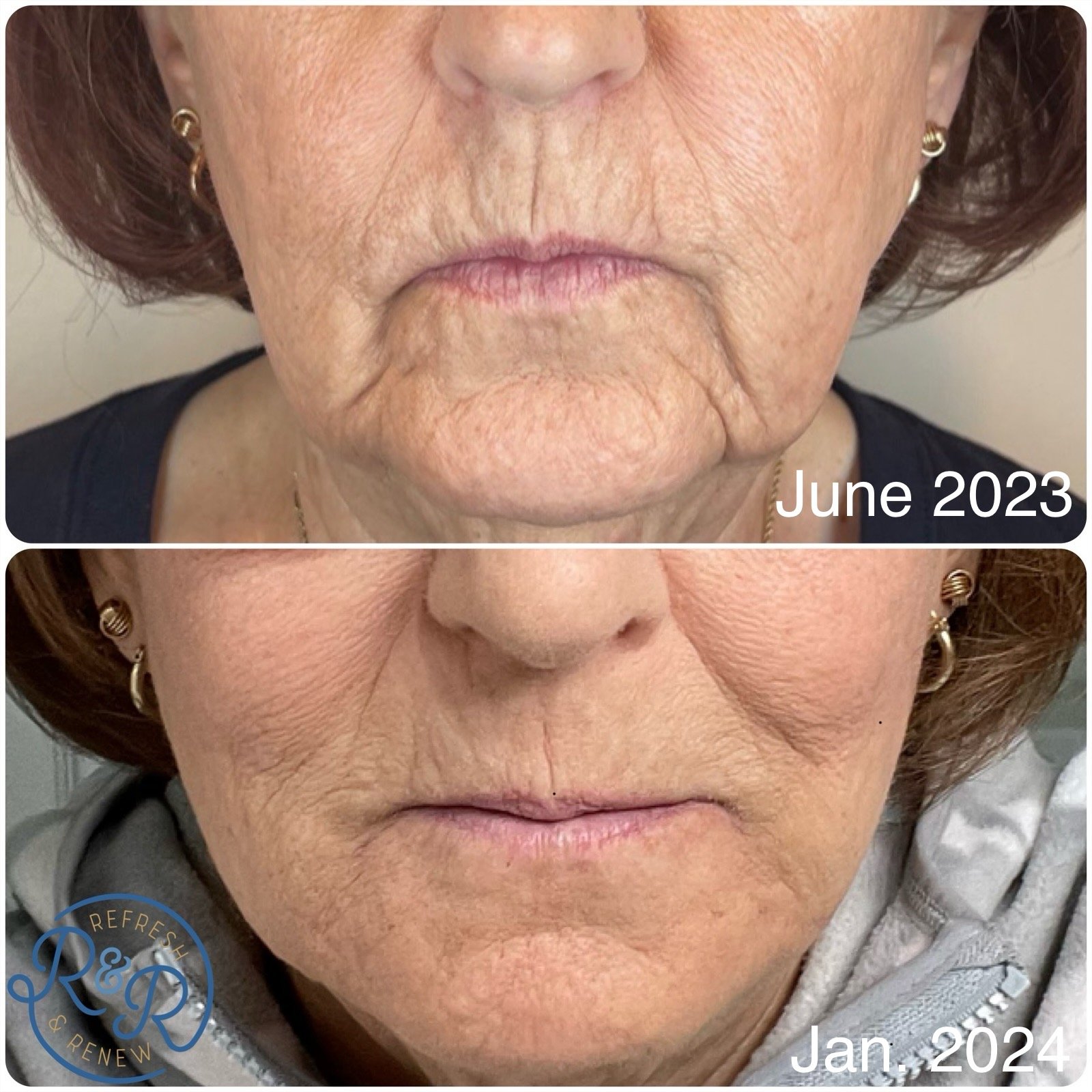 The Ultimate Showdown: Dermal Fillers vs. Biostimulators
