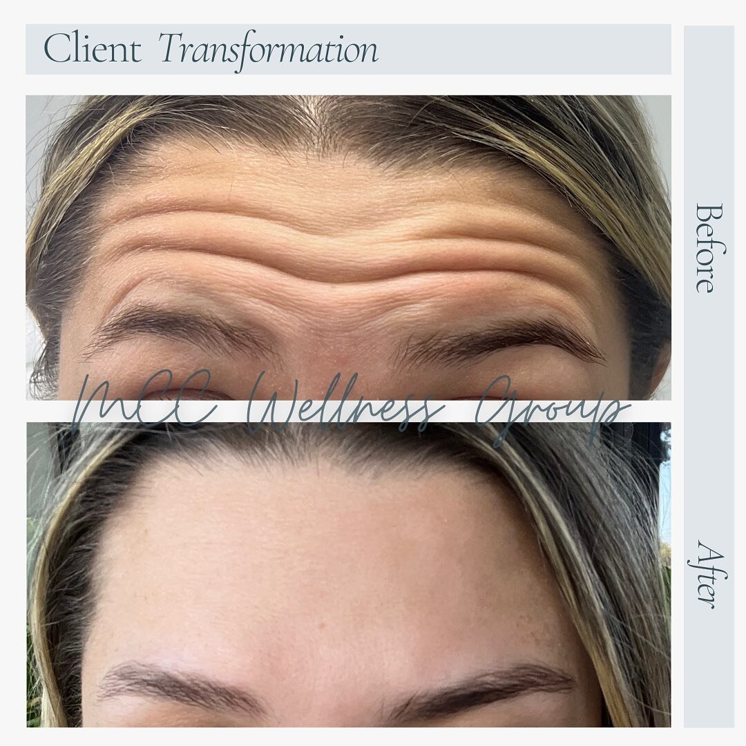 Goodbye wrinkles, Hello Confidence! ✨ Before &amp; After taken just 4 days apart! 🤩 
Achieve a smoother, younger-looking complexion with Tox! 💉 

Product Used: @galderma Dysport 

Schedule your Appointment Today!
DM us or follow the link in bio
239