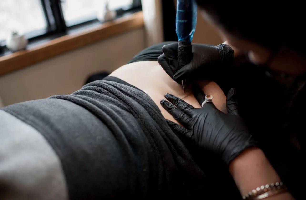 wisconsin scar camouflage + stretch mark revision