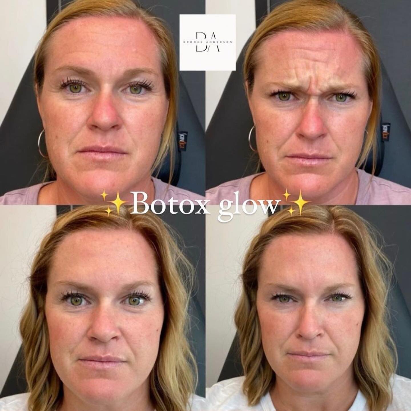 #Repost @brooke.beauty.injector
・・・
✨Just Botox ✨
This is why WE LOVE  this stuff so much!!! This beautiful lady just had her first treatment and she&rsquo;s thrilled. 

#mavenmagic #beautyinjector #mavenmedicalarts #botoxslc #allerganAmi #botoxglow