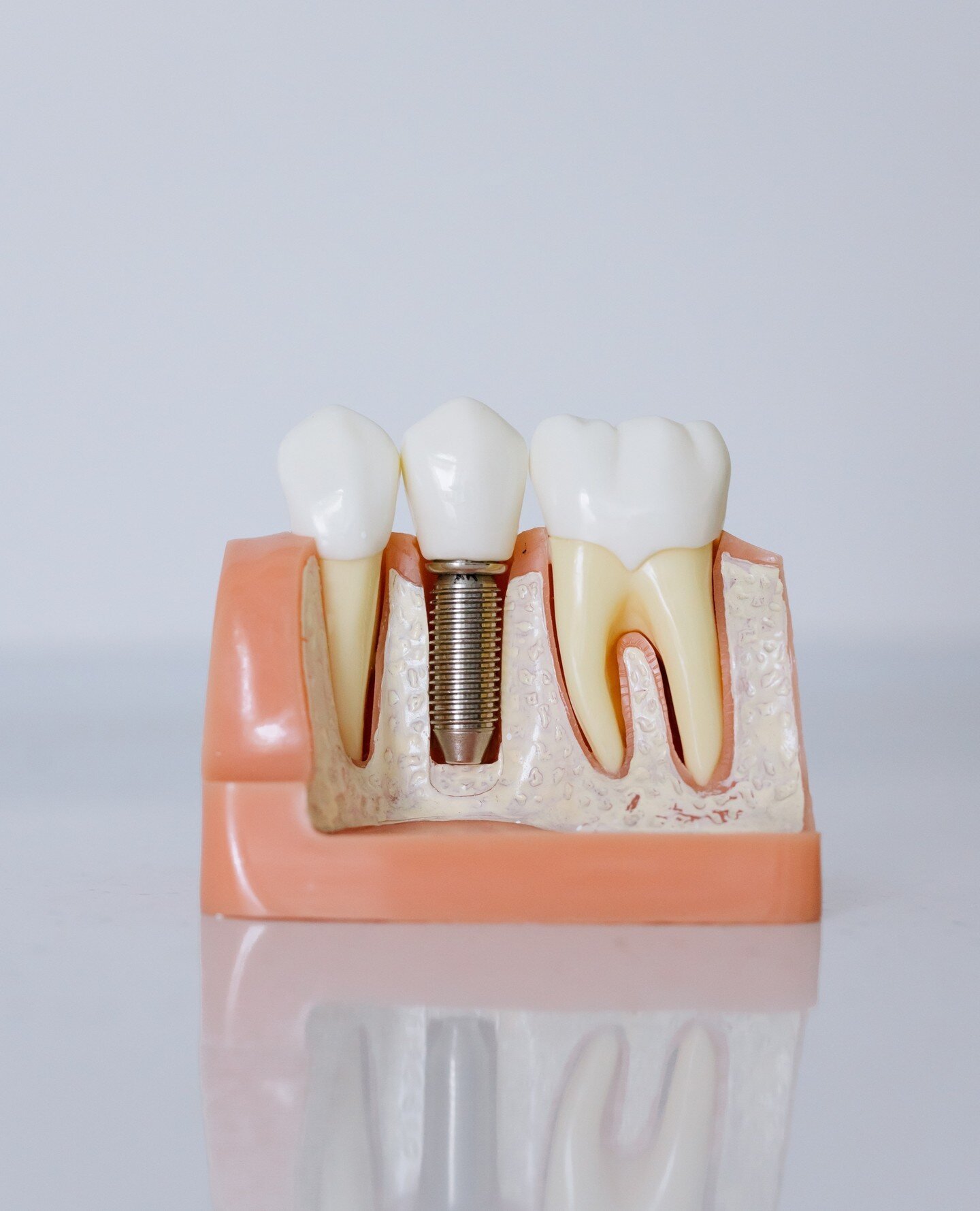 Dental implants are a common solution for singular missing teeth. 🦷 A dental implant consists of a metal post that is surgically positioned into the jawbone beneath your gums. Once in place, we then mount the replacement teeth onto the post. Implant