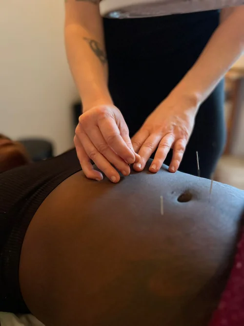 Acupuncture