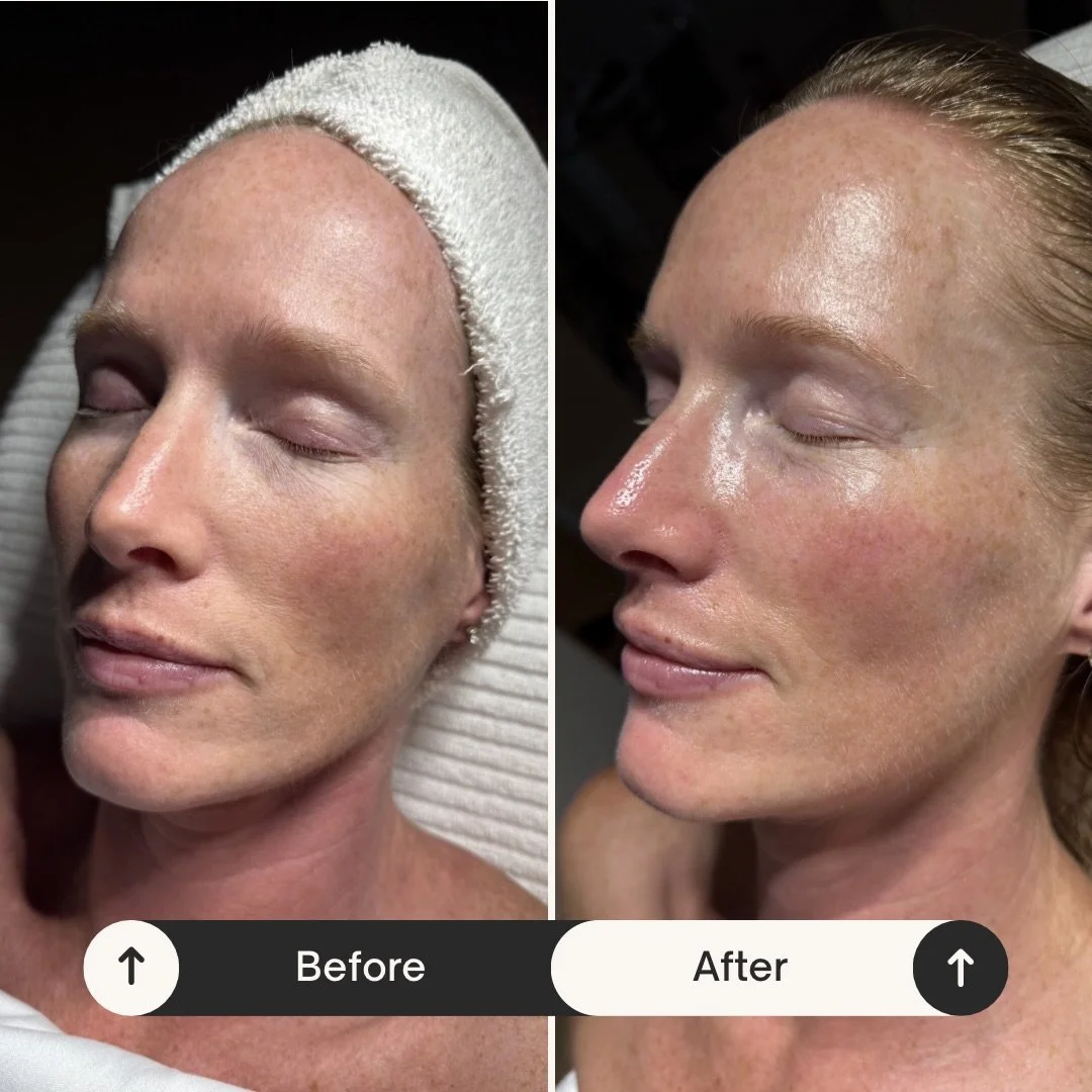 What my hands can do in 1 treatment 😎

The Deluxe Facial 

Client is visibly lifted, toned and hydrated. 

Book yours now!

#facial #winnipegsmallbusiness #winnipegfacials #facialmassage #sculpt