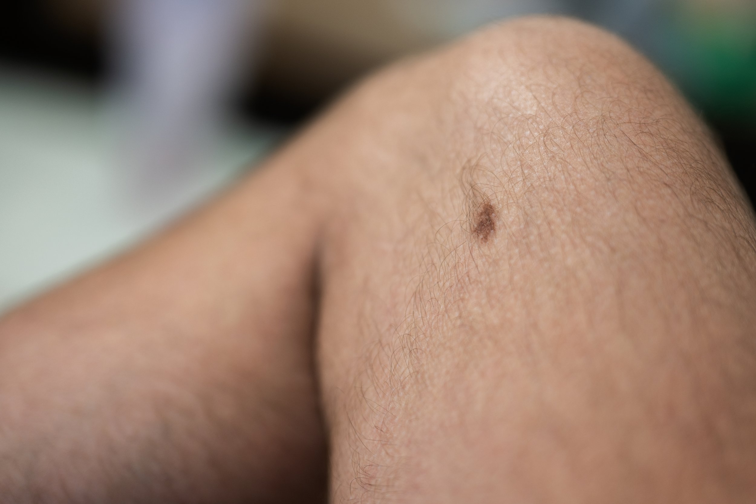 Why Do I Have Brown Spots On My Legs? — Midwest Medical Edition