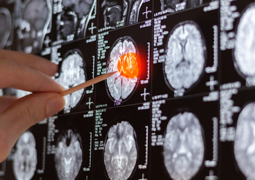 Exclusive Brain and Spine Cancer Treatments Available Only at Nebraska ...